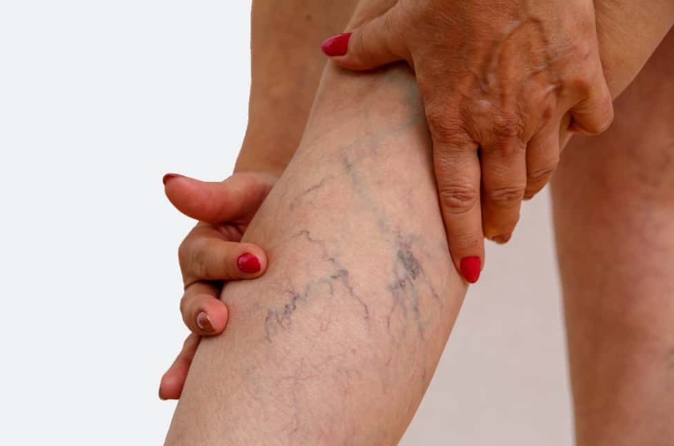 varicose veins Sydney