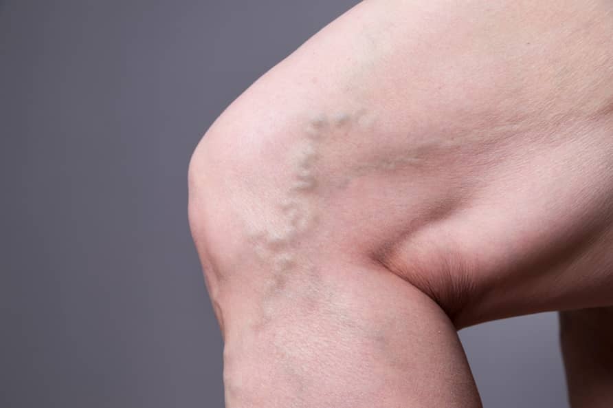 varicose veins Sydney